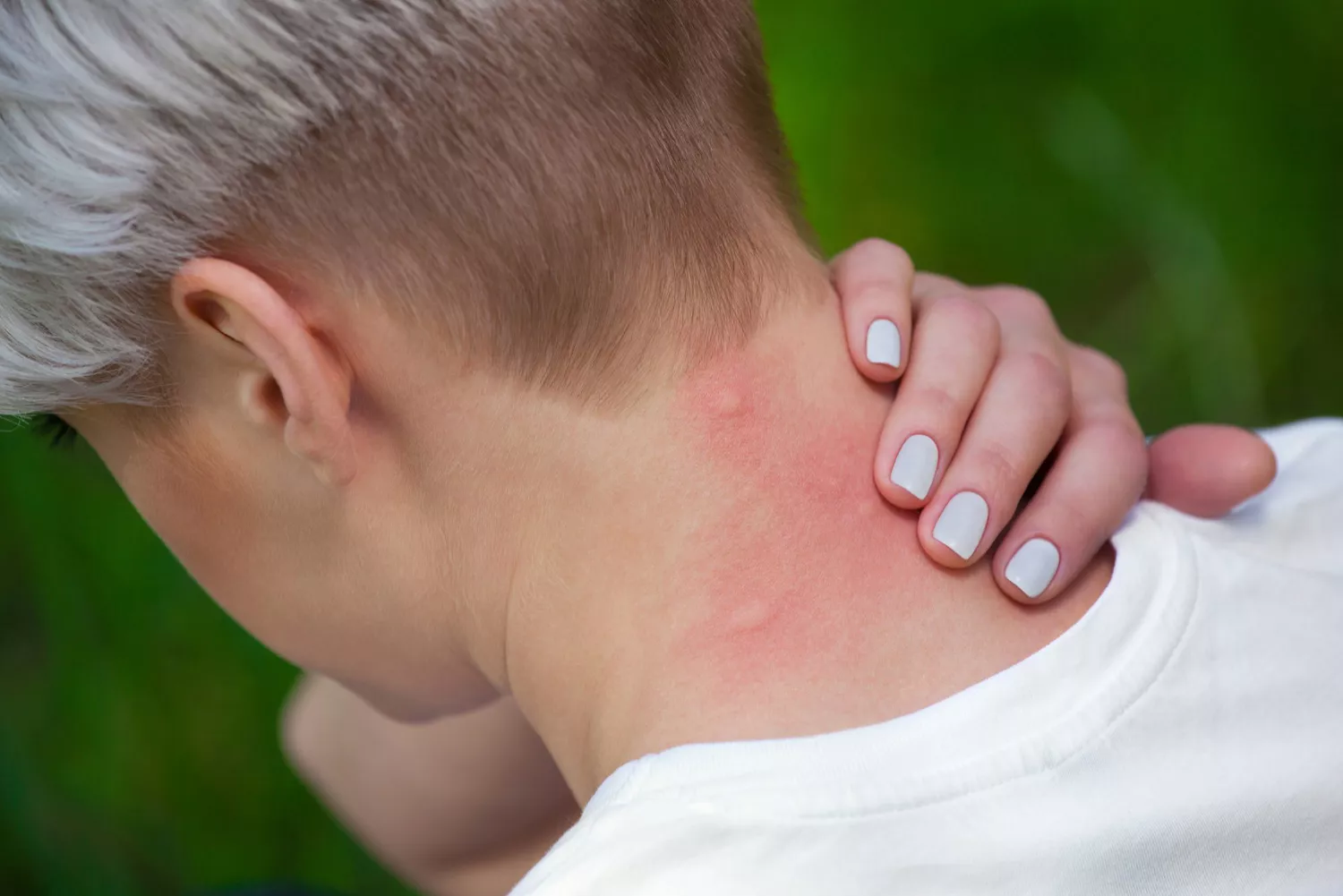 mosquito-bite-neck-GettyImages-584572080-2000-c1ef8af36f9f4bacb352f459ecef0201